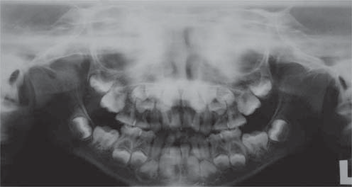 A presença de dentes supranumerários, retardo na esfoliação dos dentes decíduos e a presença de dentes não erupcionados são normalmente as principais queixas dos pacientes e o motivo pelo qual