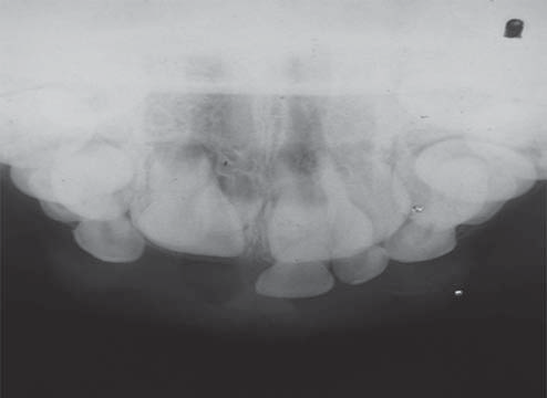 Discussão Figura 3: Radiografias oclusal aos nove anos de idade, permitindo notar a presença de dentes supranumerários na região anterior da maxila Com base nos achados clínicos e radiográficos