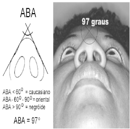 Figura 7 - Índice de Projeção do Ápice Nasal. O ABA é formado entre duas linhas tangenciais às margens das asas nasais (Figura 8).