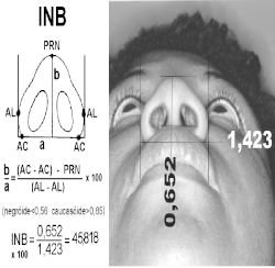O INB é a relação da medida entre o ponto PRN à linha que une ambos os pontos AC, e a medida entre o ponto mais lateral da superfície da asa nasal de cada lado