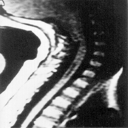 Arq Neuropsiquiatr 1998;56(1) 101 Fig 3. Mesmo caso da Figura 2, nota-se herniação das amígdalas cerebelares e cavitação siringomiélica na região cervical.