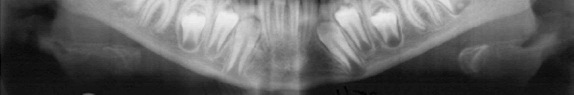 ; a angulação mesial interna de caninos permanentes não erupcionados nos lados sem protuberância canina unilateral e a comparação com o lado contra-lateral onde a protuberância era palpada.