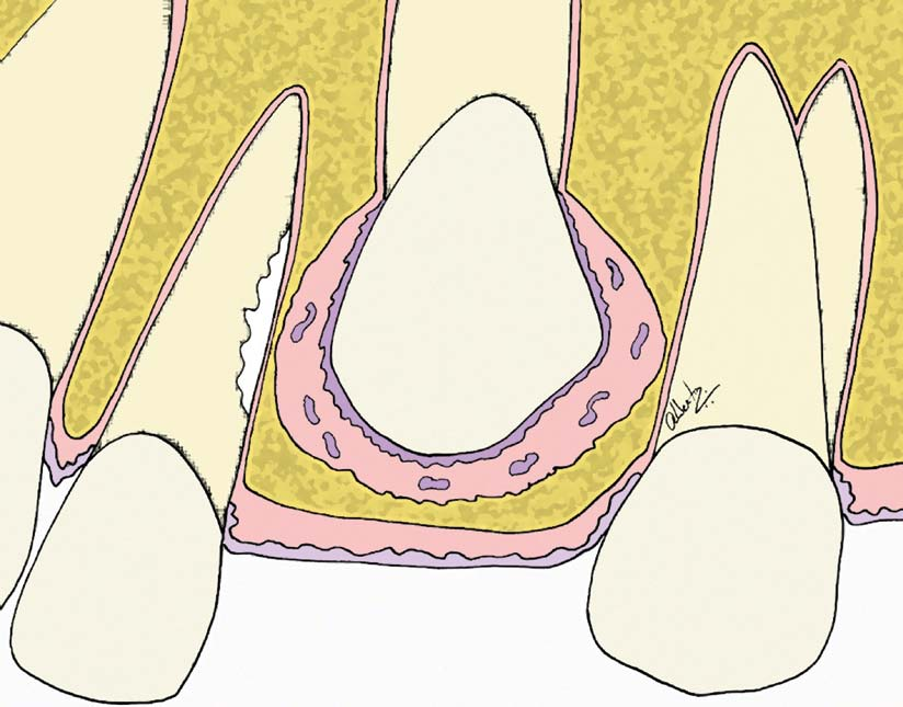 No intermédio das fibras colágenas e dos outros componentes da matriz extracelular do tecido conjuntivo folicular, se distribuem ilhotas e cordões de células epiteliais remanescentes da lâmina