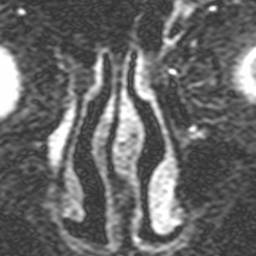 Ë possível identificarem-se o saco lacrimal (SL) e a porção proximal do ducto nasolacrimal (DNL), à direita (setas).
