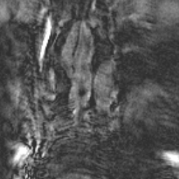 45 SL DN A B Figura 5 - Seqüência T1 gradiente-eco no plano coronal, após instilação de gadolínio diluído. Imagens-fonte com janela habitual (a) e janela invertida (b).