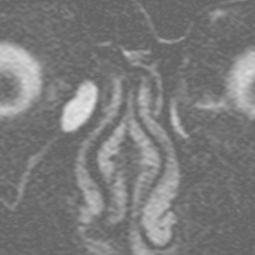 65 A B Figura 13 - Caso número 1. Seqüência STIR com instilação de soro fisiológico. Imagens-fonte, evidenciando a obstrução da via lacrimal direita, no nível do ducto nasolacrimal.