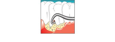 5 Comando 5.2 Indicações de aplicação trabalhar em concavidades extremas de raízes, como podem ser encontradas em alguns dentes.