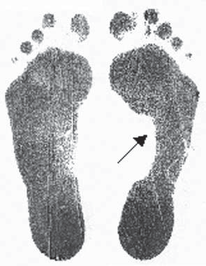 149 Estudo da prevalência... Figura 4 Pé plano unilateral de uma criança (seta). Quando se considerou o sexo, no masculino foi verificada a presença de pé plano em 25 casos (15,3%).