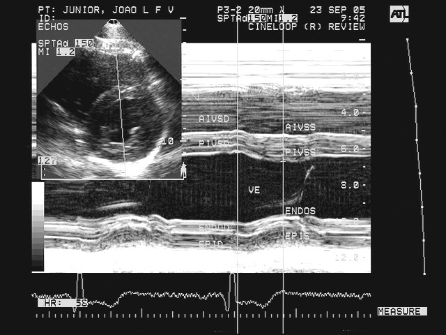 ventriculares aumentadas ou no limite superior da normalidade no ECO (Gráfico 1). As figuras 1 e 2 mostram a disparidade entre um coração normal e um com adaptações fisiológicas.