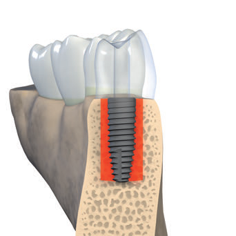 Posição orofacial do implante A camada óssea facial e palatal tem de ter, no mínimo, 1 mm de espessura, por forma a assegurar condições de estabilidade em termos dos tecidos rígidos e moles.