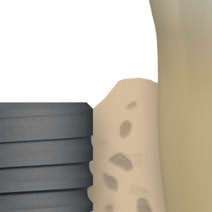 A melhor forma de colocação do implante cónico de nível ósseo consiste em posicionar o implante de modo a que o bordo exterior da pequena margem inclinada a 45 (chanfradura) fique