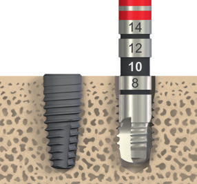 300 rpm Passo 5 Perfuração do perfil Defina a forma da parte coronal do local de implantação com a broca de perfil Ø 4,1 mm, utilizando as marcas de orientação como guias para o posicionamento