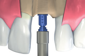 Passo 4 Corrija a orientação do implante Ao aproximar-se da posição final do implante, certifique-se de que as marcas de altura existentes na peça de transferência azul estão orientadas exatamente no