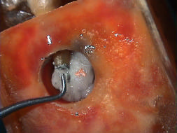 ápice dental voltado para baixo (Fig. 4.7).