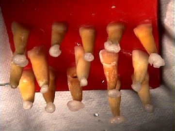66 Imediatamente após o procedimento, cada dente foi removido do simulador, fixado verticalmente pela coroa sobre uma placa de cera e o ápice envolvido por uma mecha de algodão embebida em solução