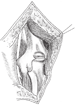 37 > Abordagem posterior do cotovelo iniciando-se proximalmente na linha média do braço posteriormente, desviando lateralmente da proeminência óssea do olécrano (linha contínua); para a abordagem