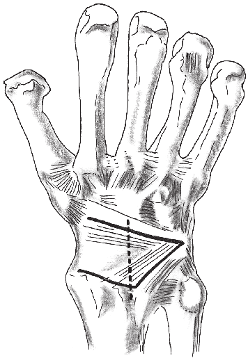 66), expondo o tendão do extensor longo do polegar e afastando-o radialmente.