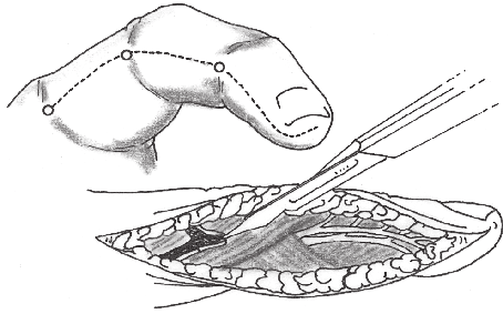 > Vias de acesso ao membro superior 1651 A Feixe vasculonervoso Incisão transtendão Incisões paralelas Ligamento retinacular transverso Ligamento de Cleland Figura 78.