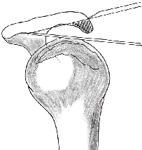 1632 Ortopedia e traumatologia: princípios e prática Bursa subacromial Marcação para acromioplastia anterior Clavícula Osteótomo para acromioplastia Osteótomo para afastar cabeça do úmero do