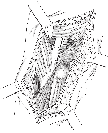 1636 Ortopedia e traumatologia: princípios e prática ser inclinada medialmente a 5 a 7 cm da prega de flexão do cotovelo, alcançando-a sempre de maneira oblíqua (Fig. 78.24).