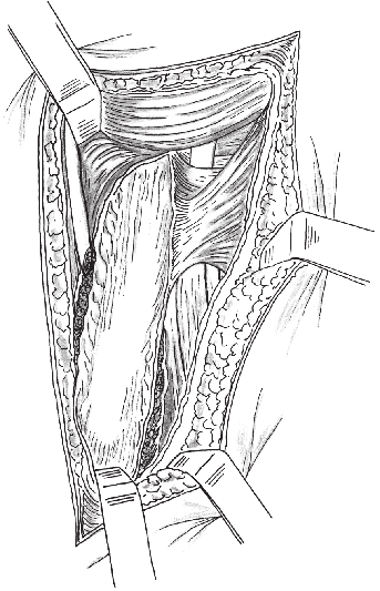Visualizam-se as inserções do deltoide e do peitoral maior e, logo abaixo, a origem umeral do braquial lateralmente ao bíceps (Fig. 78.25).