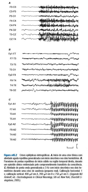 classifica os distúrbios epilépticos e