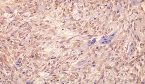 mononucleadas em lesão central de células gigantes (LSAB, 400 ).