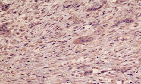 mononucleadas em lesão central de células gigantes (LSAB, 400 ). Figura 12.