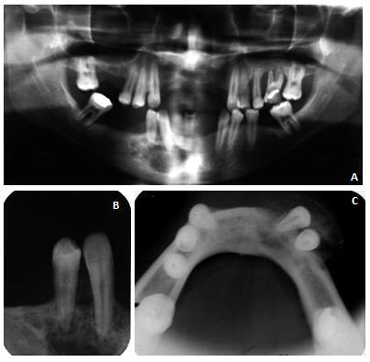 de ulceração localizada na região dos dentes 43 e 44 O exame radiográfico revelou área radiolúcida multilocular no corpo mandibular direito com destruição da cortical vestibular, sem halo radiopaco e