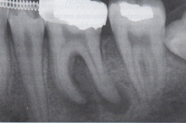 Fig. 2. Periodontite apical crónica. Lesões periapicais discretas associadas ao ápice do primeiro molar inferior. 20 3.