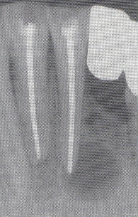 Características radiográficas Os achados radiográficos assemelham-se aos da periodontite apical crónica. 2 Observase a perda da lâmina dura e uma IR que circunda o ápice do dente.