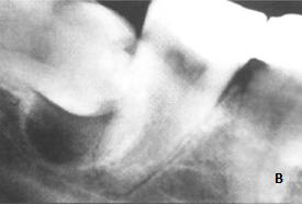 periodontais de algum dente adjacente. 20,22 Características radiográficas Normalmente observa-se uma IR unilocular com bordo regular associada com a coroa de um dente incluso.
