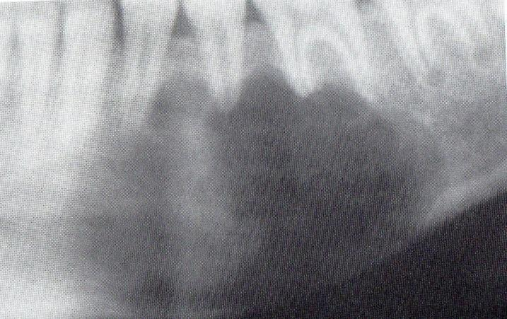 Dor ou parestesia podem ocorrer somente quando há uma estreita relação com o nervo alveolar inferior e o deslocamento dos dentes envolvidos não é um achado comum, embora existam relatos que o afirmam.