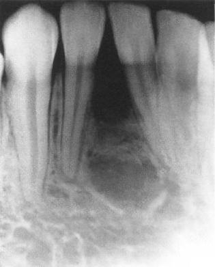 Em 50% dos casos observam-se migrações dentárias e reabsorção radicular dos dentes envolvidos na lesão.