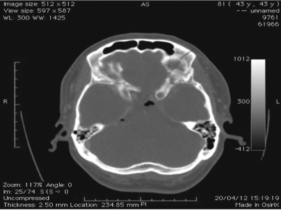 Introdução O pneumoventrículo e a fístula liquórica são possíveis complicações decorrentes do traumatismo cranioencefálico (TCE), principal causa de morbimortalidade relacionada ao trauma no Brasil.