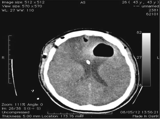 Fig. 2 Tomografia Computadorizada pré-operatória mostrando volumoso pneumoventrículo hipertensivo. deterioração neurológica.