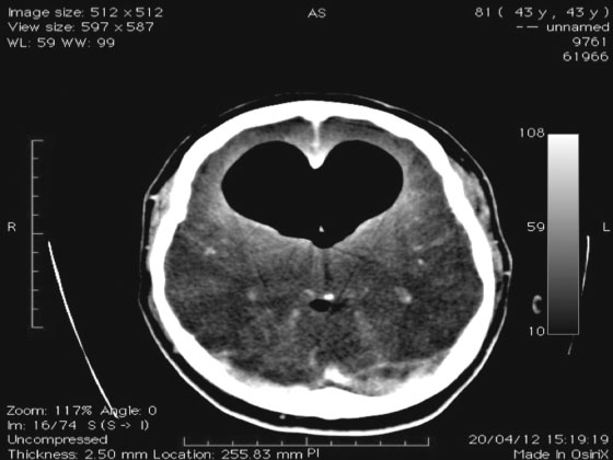 consequentes à hipertensão intracraniana. 1,4 9 O tempo de aparecimento dos sintomas é variável.