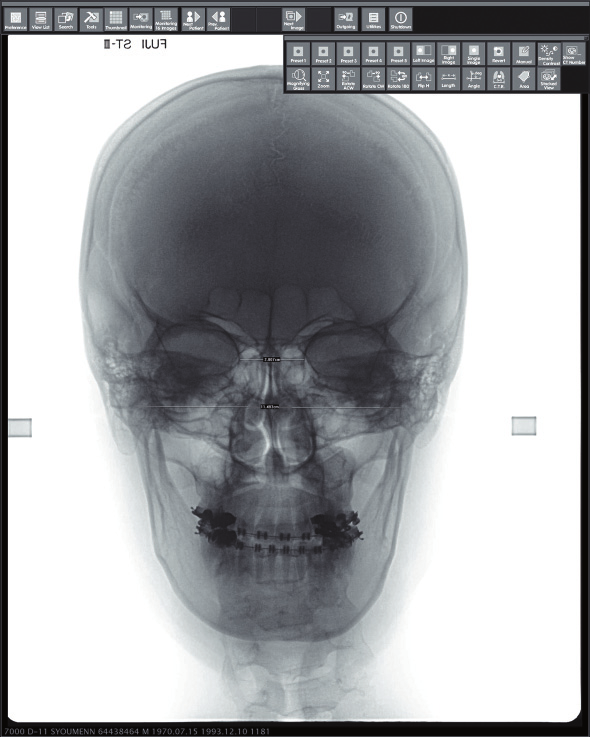 nasal, o canal mandibular e o forame mental na mandíbula (Figura 4). Podemos delimitar e visualizar melhor os processos patológicos que envolvem o complexo maxilo-mandibular.