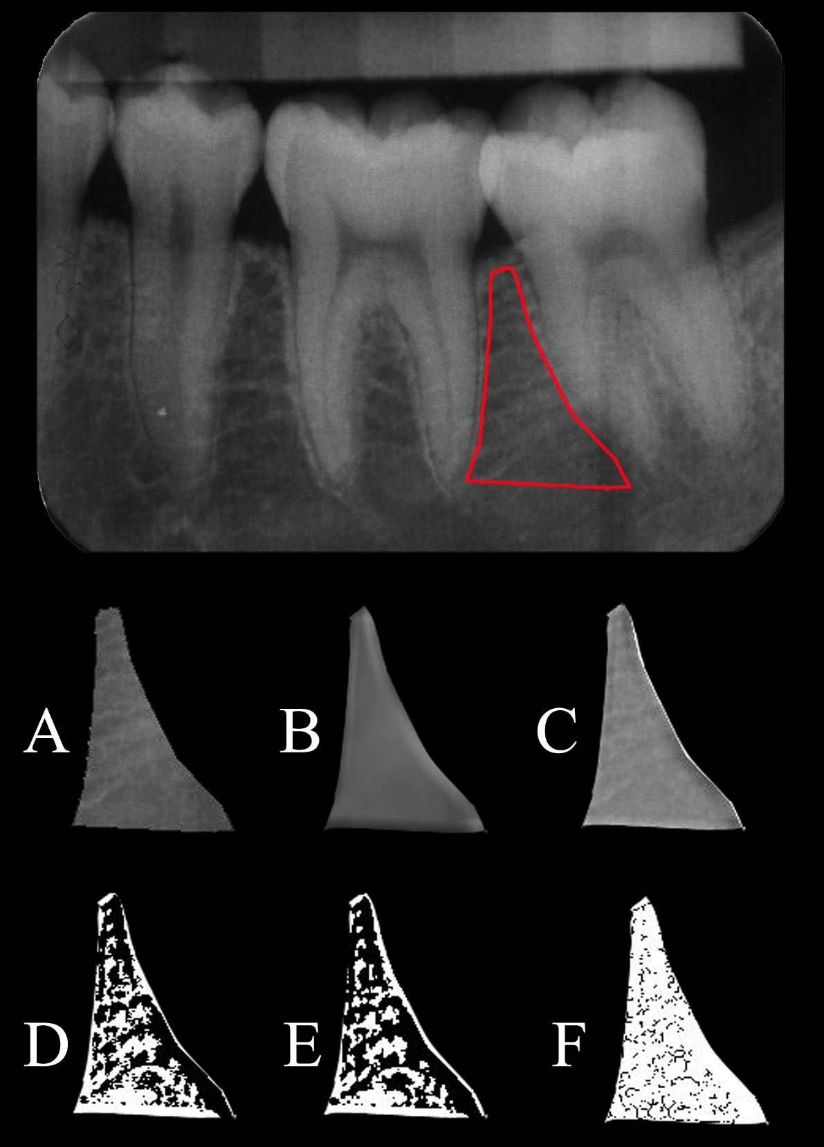 Figura 3. Seqüência do processamento de imagens da área selecionada de uma das radiografias da amostra.