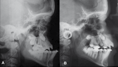 Tratamento cirúrgico das craniofacioestenoses sindrômicas: avanço facial com distrator externo Figura 1 Teleradiografias em norma lateral, realizadas no pré (A) e pós-operatório (B).