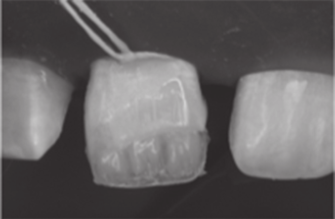 O primeiro incremento de resina (cor CT) foi realizado na barreira de silicone, sendo, em seguida, adaptado ao dente e