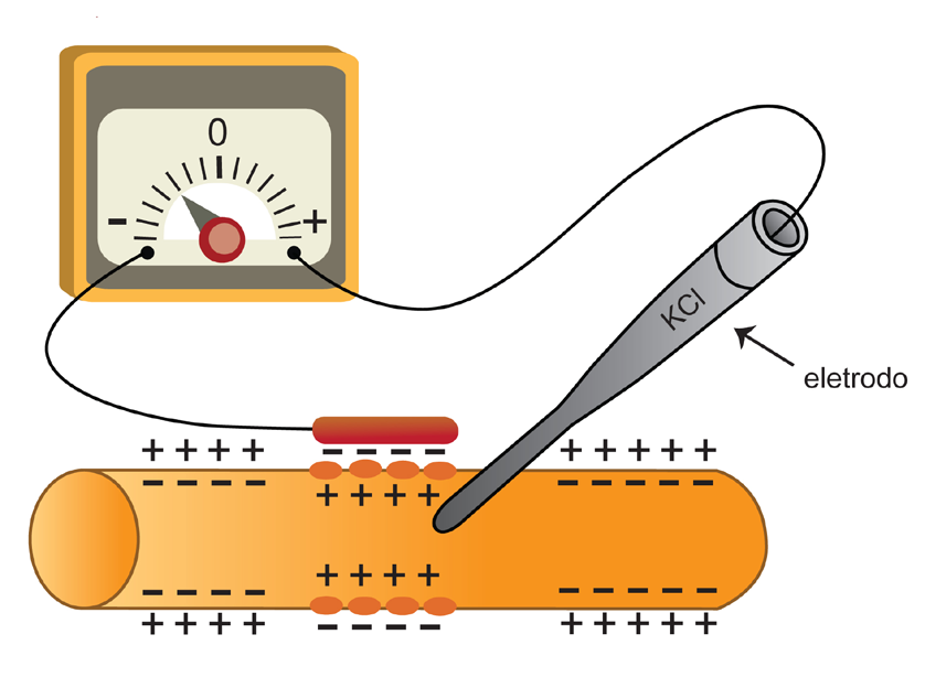 Eletromagnetismo» Sinais Elétricos no Corpo Humano 17 Assim, em algum ponto do axônio, gera-se uma perturbação, uma alteração na diferença de potencial de repouso.