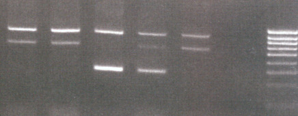 Gene: HBB CD 6: GAG>GTG (c.20a>t) p.