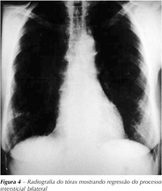 DISTÚRBIO RESTRITIVO Pneumonia por Amiodarona, 45 dias após interrupção CVF=2,21 (84%) VEF1=1,66 (84%) VEF/CVF=75% NORMALIZAÇÃO FUNCIONAL Gulmini L, Pereira CAC.