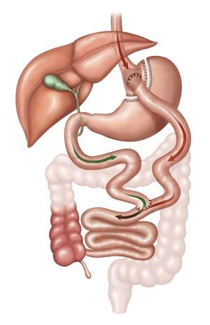 GBP Grampeamento com secção do estômago (formando a gastroplastia ou câmara gástrica), reduzindo sua capacidade em mais de 90%, Desvio (Bypass) do intestino