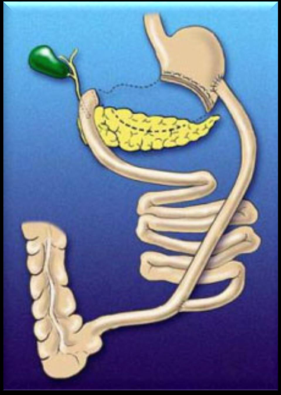 Scopinaro Gastrectomia (retirada do estômago) parcial ou um grampeamento com secção simples do estômago, reduzindo sua capacidade em cerca de 50%, Intestino delgado é seccionado a 2,5 metros de onde