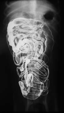 nenhum dos pacientes demonstrou reação significativa de desconforto mediante a passagem da sonda. Ackerman (2002) e Jung et al.