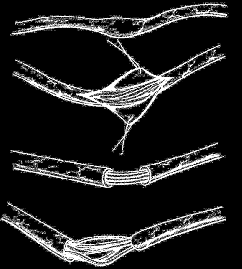 39 a) b) c) d) Figura 06 Procedimentos de neurólise. a) neurólise simples, b) epineurotomia, c) epineurectomia e d) neurólise intra-fascicular. Adaptado de Ducloyer e colaboradores, 1990.