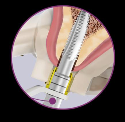 Macho de Rosca Alvim Guided Surgery - Possibilita ajustar o protocolo cirúrgico à classe de osso, para alcançar excelente estabilidade primária do implante. - Osso tipo I e II para implantes Alvim.