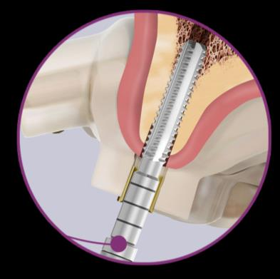 Macho de Rosca Facility Guided Surgery - Possibilita ajustar o protocolo cirúrgico à classe óssea, para alcançar excelente estabilidade primária do implante.